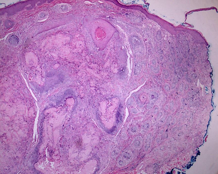 Figure 1: Islands of basaloid, transitional and ghost cells of pilomatrixoma and nests of basal cells of BCC (x40 H&E).