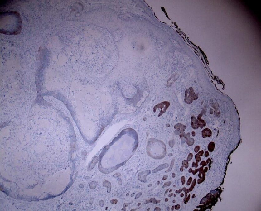 Figure 3: BerEP4 positive staining of BCC and negative staining of pilomatrixoma (x40).