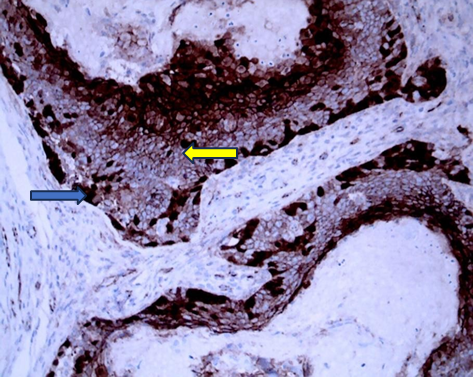 Figure 5: Strong nuclear β-catenin positivity of basaloid cells (Blue arrow) and negative or faint cytoplasmic staining of transitional cells and ghost cells in pilomatrixoma (yellow arrow) (x100).