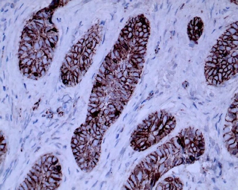 Figure 6: β-catenin nonspecific cytoplasmic /membrane staining of BCC (x100).