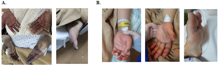 Figure 1: Raynaud’s phenomenon. A. Hands and feet taken on Day 1 of hospitalization. B. Taken on Day 3 of hospitalization.