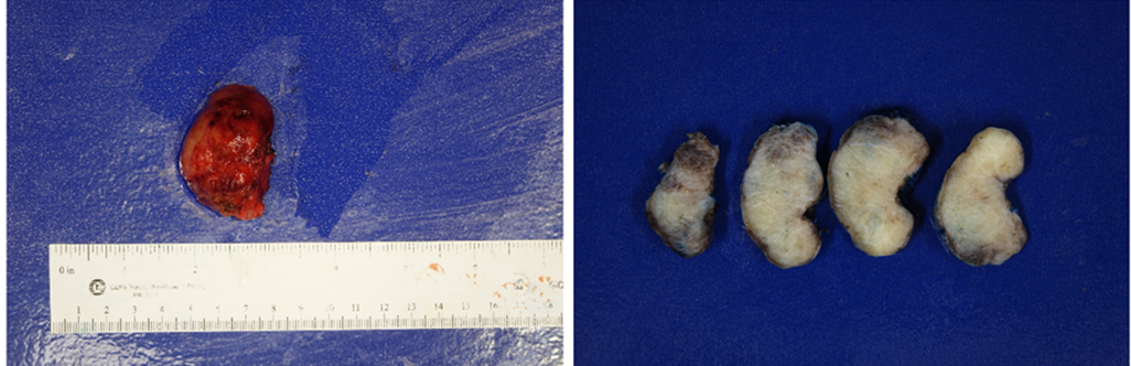 Figure 3: Surgical specimen of right tonsil mass. Serial sectioning of specimen reveals a white whorled cut surface with no evidence of hemorrhage or necrosis.