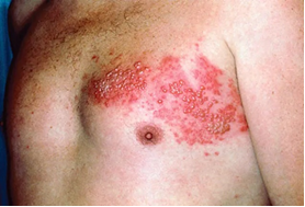 Figure 3: Shingles Self Case: Front &around chest 3-5 rib space.