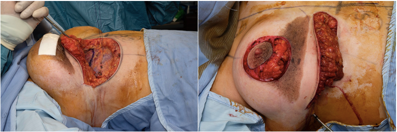 Figure 2: Recruitment of upper abdominal skin in a reverse abdominoplasty manner.