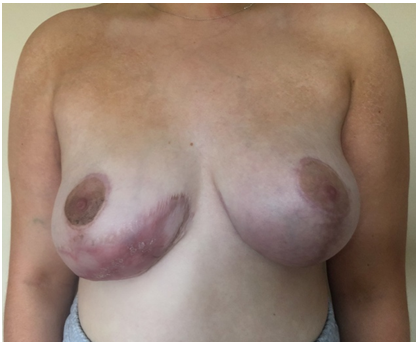 Figure 3: (a) Recreation of the IMF after a reverse abdominoplasty approach (b) Doughnut circum-areolar mastopexy of the right breast. The dermis was only incised inferiorly, leaving a generous superior dermo-glandular flap.