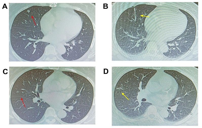 Figure 2: In case 2, A Red arrow points to a pulmonary nodule in the right middle lobe before surgery. B yellow arrow points to another pulmonary nodule in the right middle lobe before the operation. C The red arrow points to a pulmonary nodule located by Hook wire before operation. D The yellow arrow points to another pulmonary nodule located by the Hook wire before the operation, which fell out during the operation.