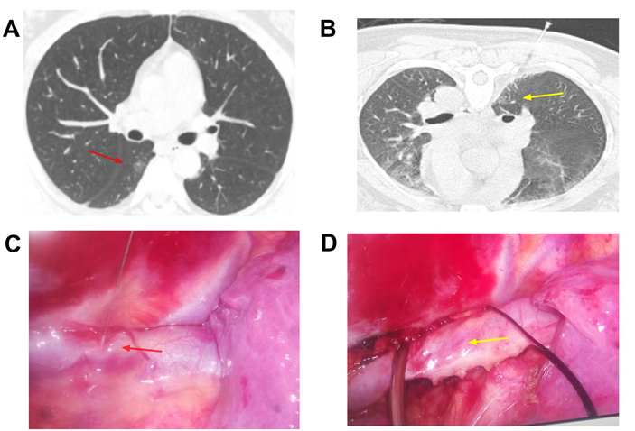 Figure 3: In case 3. A Red arrow points to a pulmonary nodule in the right lower lobe before surgery. B Yellow arrow points to a pulmonary nodule located by Hook wire before operation. C The red arrow points to the Hook wire penetrating the azygos arch image. D the Hook wire is removed.