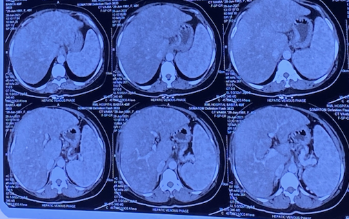 Figure 1: Multiple ill-defined hypodense lesions present in Liver and spleen with Hepato-splenomegaly in contrast enhanced CT scan.