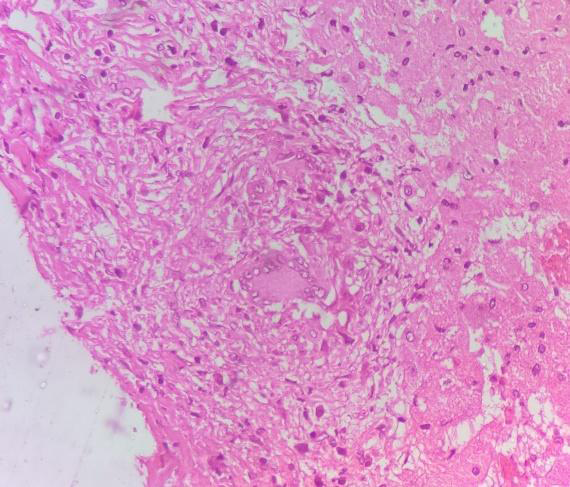 Figure 2: non- necrotizing epitheloid cells with elongated nuclei (bold arrow) with Langhans foreign body giant cells (arrow).