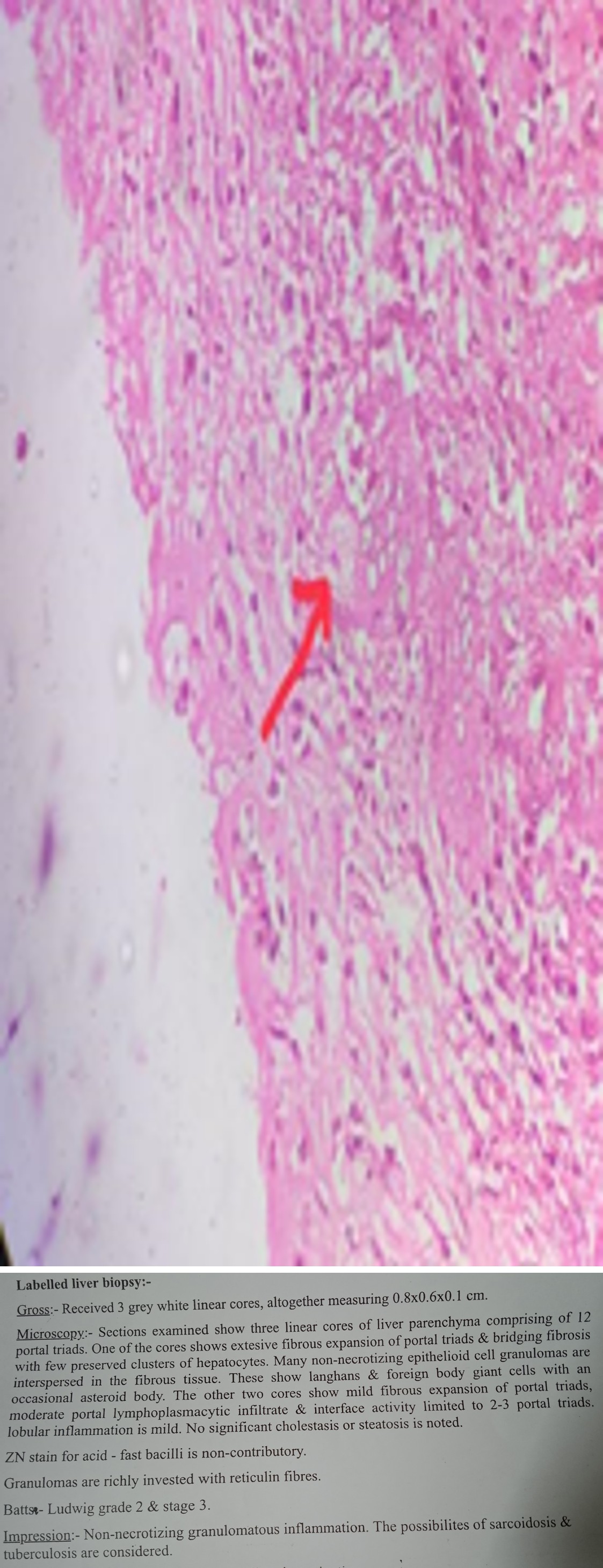 Figure 3: Asteroid body (arrow mark).