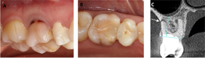 Figure 1: Baseline buccal and occlusal views of the maxillary right first molar (#16), indicated for extraction. #15 had a failed root canal treatment, and has been endodontically retreated and provisionally restored during the interim period (A,B). Cross- sectional view of baseline CBCT scan showed buccal fenestration of the #16. The while arrow points to the most apical part of the buccal defect.