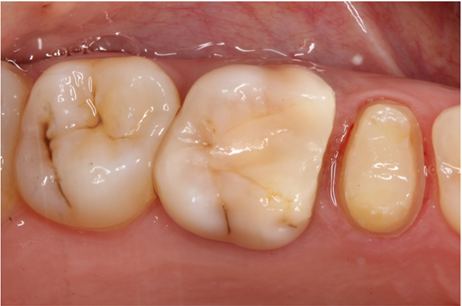 Figure 2: The #15 was prepared to receive a distal cantilevered acrylic bridge.