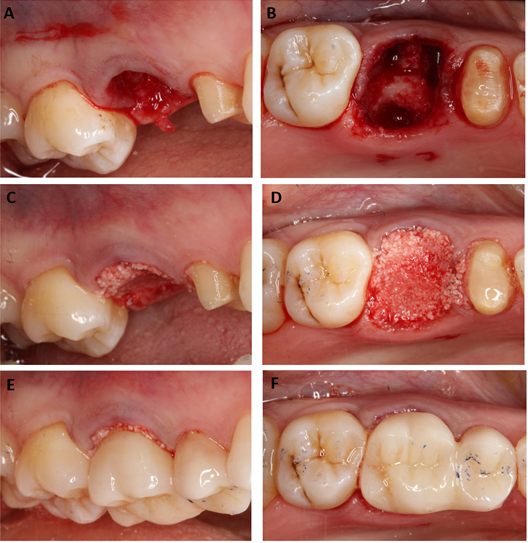 Figure 4: #16 was minimally traumatically extracted. The extraction socket was filled with deproteinised bovine bone (0.25- 1mm BioOSS granules, Geistlich) and socket sealed using ovate pontic of the distal cantilever bridge. The pontic has been adjusted to remove all contacts in static and dynamic occlusion.
