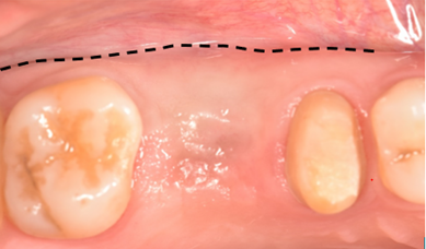 Figure 5: The alveolar ridge at 6 months following extraction highlights the ridge augmentation in the horizontal dimension. The dashed line outlines the buccal extent of the augmented ridge, which has enabled the implant to be placed in the prosthetically driven position.