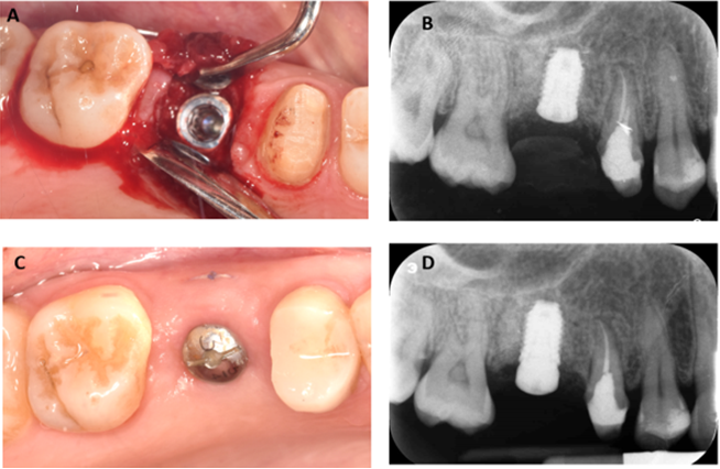 Figure 7: 6 months following the extraction, a 8.5x4mm (3i) implant fixture placed (A) and periapical radiograph showing fixture and cover screw in place (B). Occlusal view at 3 months following implant placement and periapical radiograph showing healing abutment in place (C, D).