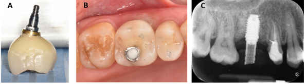Figure 8: Fabrication of the provisional screw-retained restoration (A). Provisional restoration fitted at the site of #16 (A). Periapical radiograph showed complete seating of the temporary abutment (B).
