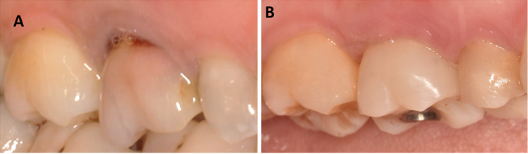 Figure 9: Buccal view of tooth #16 at baseline (A) and with implant provisional restoration in place at 1 year (B).