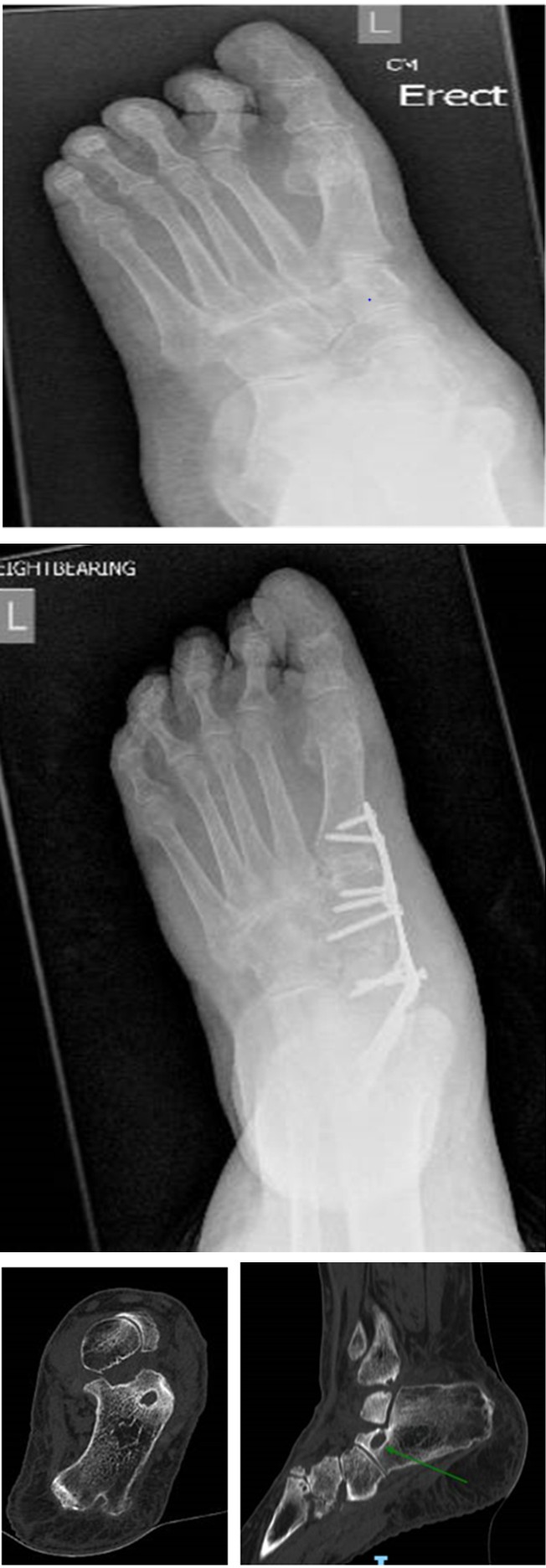 Figure 1: • Medial column shortening and lengthening of lateral column (1) • Medial column fusion (talus to medial cuneiform) (2)