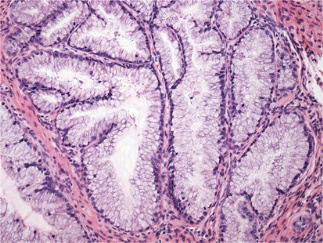 Figure 1: Lobular endocervical glandular hyperplasia demonstrating lobular architecture comprised of glandular articulations layered by tall, columnar, mucin secreting epithelium imbued with eosinophilic cytoplasm, basal nuclei and minimal atypia. Mitotic activity is minimal [8].