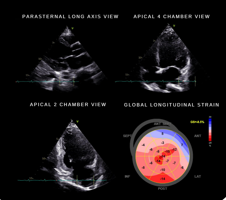 Figure 1: 2D Echocardiography: Dilated left ventricle. Eccentric left ventricular hypertrophy with severe global hypokinesia. Reduced left ventricular ejection fraction of 28% by Simpson’s. Abnormal average global longitudinal strain. (bottom right image). Normal left and right atrial diameter. Normal right ventricular dimension with adequate systolic function. Mild pulmonary hypertension Compared with previous echo three years prior: Left ventricular ejection fraction decreased from 71% to 28%.