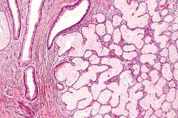 Figure 1: Tunnel clusters of uterine cervix composed of endocervical glands with cystic dilatation. Layering cuboidal to columnar epithelium is bland with apical intracytoplasmic mucin vacuoles and basal nuclei. Cytological or nuclear atypia is minimal to absent. Circumscribing stroma is fibrotic [8].