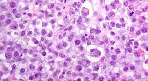 Figure 1: SMARCA4-deficient undifferentiated tumour delineating sheets and non-cohesive monomorphic cells imbued with moderate to abundant cytoplasm, variegated nuclei and prominent nucleoli. Pleomorphic cells are commixed with few rhabdoid cells.