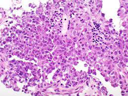 Figure 2: SMARCA4-deficient undifferentiated tumour demonstrating sheets of monotonous tumour cells pervaded with moderate cytoplasm, variegated nuclei and prominent nucleoli. Focal tumour necrosis and pleomorphic cells are expounded.