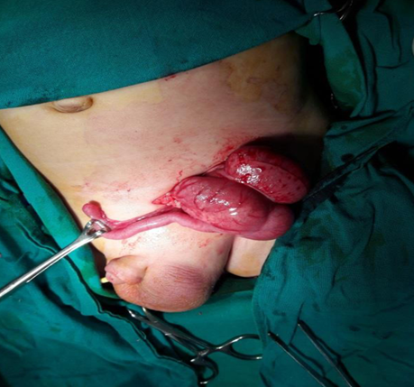 Figure 1: Intraoperative findings of a left Amyand hernia contain appendix and cecum.