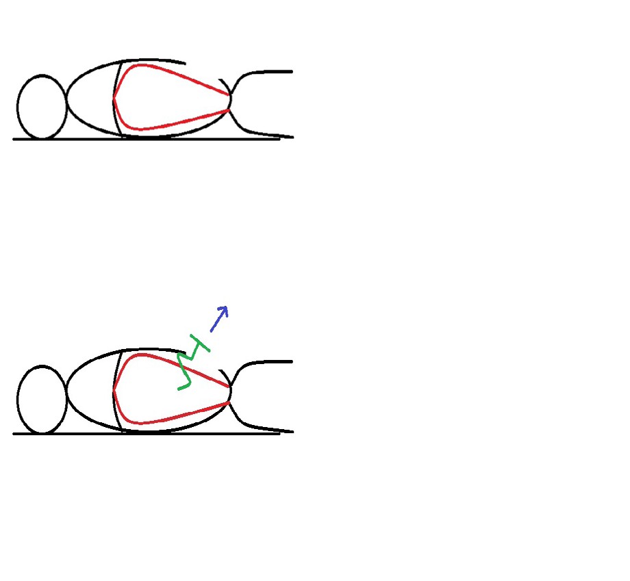 Figure 1: ** steps of delivering the fibroid uterus out from the peritoneal cavity.