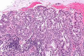 Figure 1: Microglandular hyperplasia demonstrating numerous glandular articulations layered by cuboidal to low columnar epithelium pervaded with vacuolated cytoplasm, uniform nuclei and indistinct nucleoli. Surrounding stroma is fibrotic and infiltrated by acute and chronic inflammatory cells as neutrophils and lymphocytes [5].