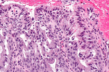 Figure 2: Microglandular hyperplasia delineating numerous glandular configurations layered by cuboidal to low columnar epithelial cells imbued with vacuolated cytoplasm, fine nuclear chromatin and indistinct cytoplasm. Circumscribing stroma is fibrotic, inflamed and infiltrated by acute or chronic inflammatory cells [6].