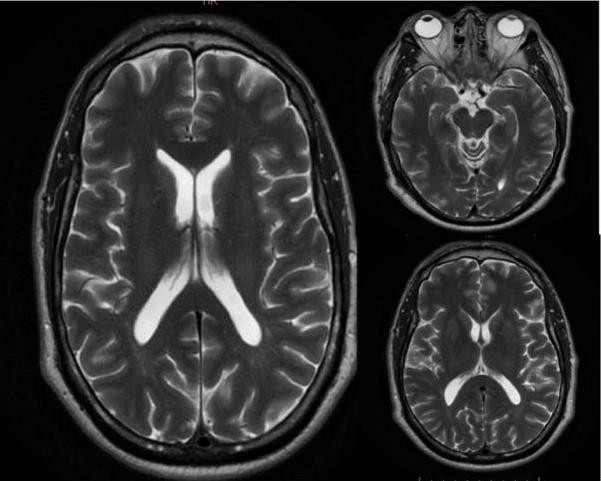Figure 1: Normal T2-weighted Brain Magnetic resonance imaging (axial).