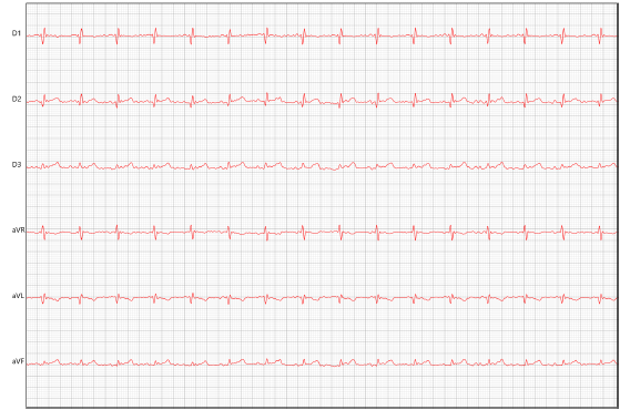 Figure 3: Electrocardiogram. Presence of sinus rhythm with increased duration of the QRS complex,suggesting left ventricular overload.