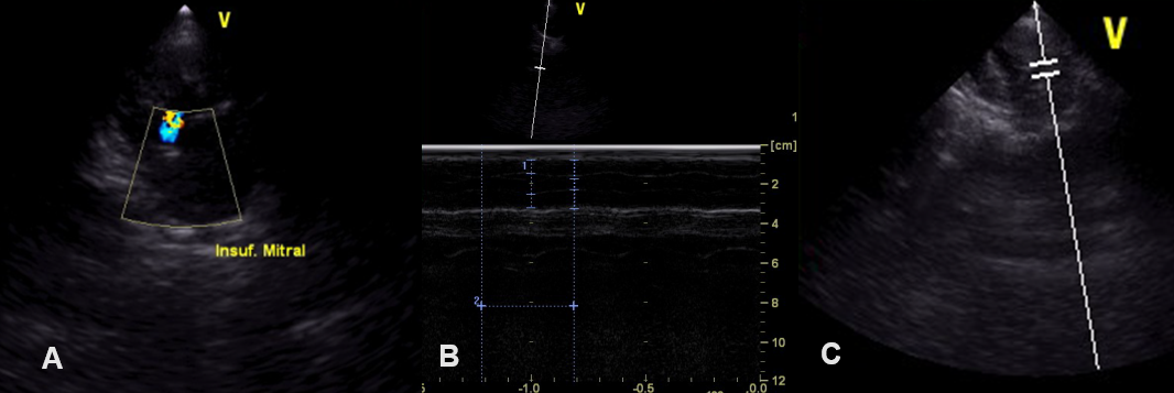 Figure 4: ** Doppler echocardiography.