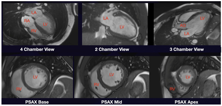 Figure 2: Cardiac MRI taken 77 after Guideline-Directed Medical Therapy.