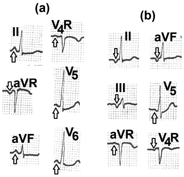 Figure 1: a: Resting supine electrocardiogram. It shows positive P waves in leads II, aVF, V4R, V5 and V6 (marked as ↑) and negative P wave in lead aVR (Marked as ↓). These findings are suggestive of normal sinus rhythm. b: Electrocardiogram recorded during the first minute of recovery. It shows the inversion of P waves in leads II, III, aVF, V4R (marked as ↓) and positive P waves in leads aVR and V5 (marked as ↑). PR interval is normal. These findings are suggestive of ectopic focus in the posteroinferior right atrium.