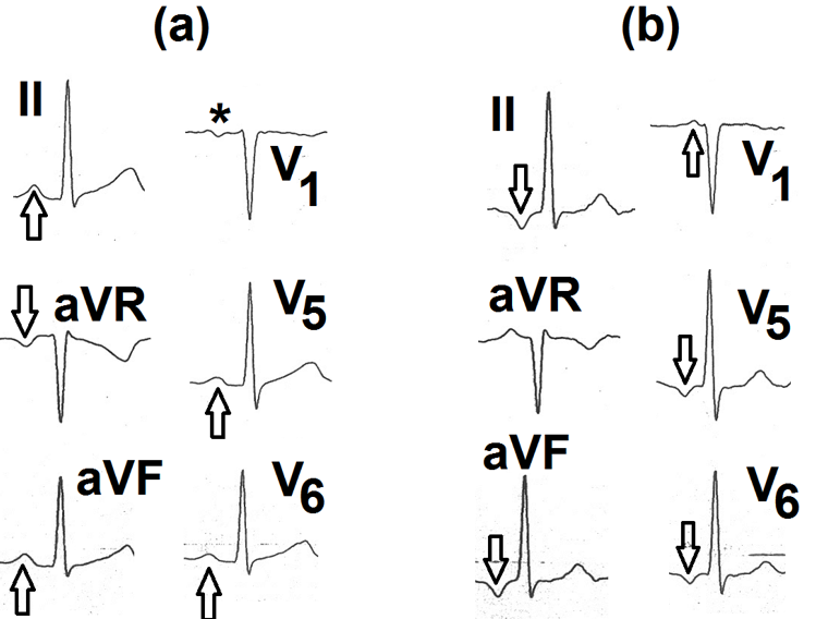 Figure 2: a: Resting supine electrocardiogram showing positive P waves in leads II, aVF, V5 and V6 (marked as ↑). P wave is inverted in lead aVR (marked as ↓) and is biphasic (+/-) in lead V1 (marked as ∗) Findings are suggestive of normal sinus rhythm. b: Electrocardiogram recorded during the second minute of recovery. It shows inverted P waves in leads II, aVF, V5 and V6 (marked as ↓). P waves are positive in leads aVR and V1 (marked as ↑). The PR interval is normal. These findings are suggestive of ectopic focus in the inferoposterior left atrium.