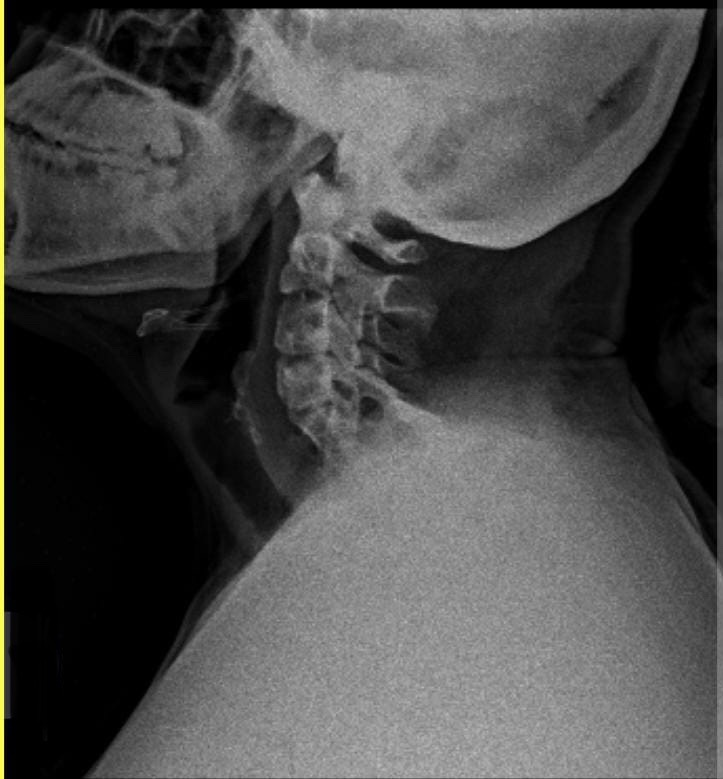Figure 3: X ray Neck Lateral View.