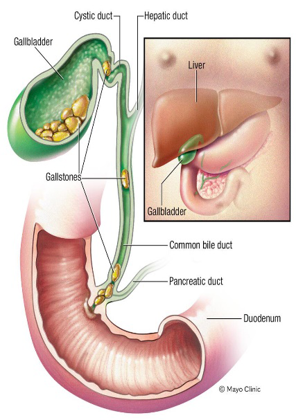 Figure 1: ** Gallbladder and gallstones [5].
