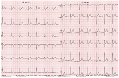 Figure 2: Preoperative electrocardiography (ECG) showed a normal sinus rhythm without repolarization or conduction abnormalities.