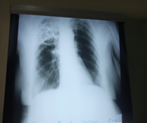 Figure 1: Chest X-ray before the use of Nimotuzumab.