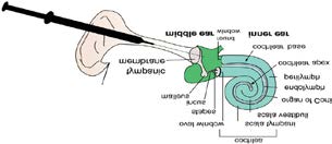 Figure 1: An illustration of the inner ear’s structure and intratympanic medication administration.