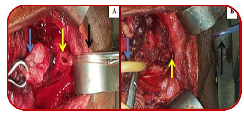 Figure 1: Intraoperative Images. A Intraoperative findings displaying transected oedematous bladder neck (blue arrow), feeding tube in distal urethral stump (black arrow), and anterior vaginal wall laceration (yellow arrow); B: Appearance after primary reconstruction of bladder neck and anterior vaginal wall showing suprapubic cystostomy catheter (blue arrow), silicon urethral stent (black arrow), and site of bladder neck reconstruction (yellow arrow).