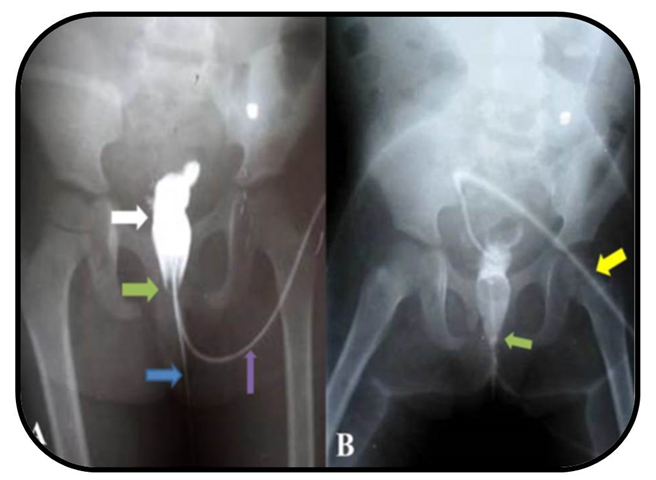 Figure 2: Postoperative contrast imaging studies at postoperative day 21. A Pericatheter RUCG showing the contrast filled bladder (white arrow), site of urethrovesical anastomosis demonstrating no contrast leak (green arrow), silicon urethral catheter/stent (blue arrow), and periurethral catheter for contrast administration (purple arrow) and B: VCUG (diluted contrast) site of urethrovesical anastomosis demonstrating no contrast leak (green arrow) and suprapubic cystostomy catheter (yellow arrow).