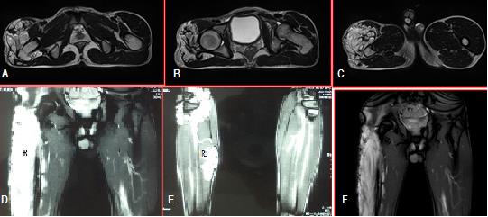 Figure 2: (A-F) showing MRI scans for comparison of the two legs with hemangiomas, hypertrophied muscles and femur in right thigh.