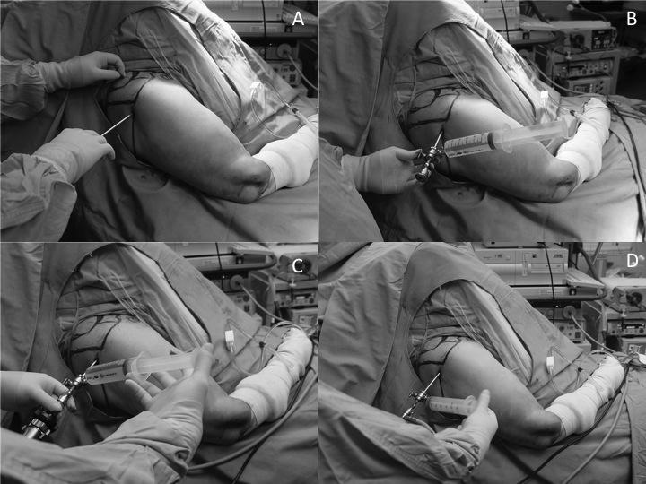Figure 1: Entering the joint with the canula (A), Connecting a 50 cc injector the the canula (B), the connection of the arthroscope (C), Pumping 50 cc Air into the joint.
