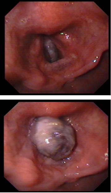 Figure 1: ** Endoscopic View of Large Subglottic Polyp.