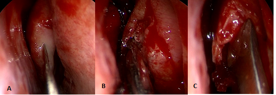 Figure 1: Bipedicled Mucoperiosteal Flap of the Middle Turbinate- A: Anterior Incision; B: Medial and Lateral Subperiosteal Dissection; C: Resection of the Underlying Turbinal Bone.