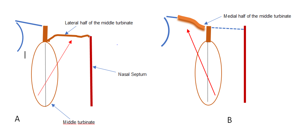 Figure 2: Bipediculated Middle Turbinal Flap A: Reconstruction of a Defect in the Ethmoid Cribiform Plate by Rotating the Lateral Half of the Middle Turbinate Medially; B: Reconstruction of a Defect Lateral to the Middle Turbinate by Rotating the Medial Half Laterally. (Arrows Indicate the Direction of Flap Rotation).