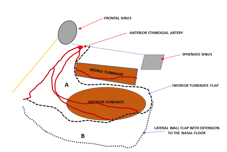 Figure 3: A: Inferior Turbinate Flap with Anterior Pedicle (Anterior Ethmoidal Artery, Lateral and Angular Nasal Artery: Branches of the Facial Artery); B: Nasal Lateral Wall Flap (Extension to the Floor of the Nasal Cavity).